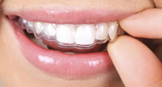 Alineadores invisibles