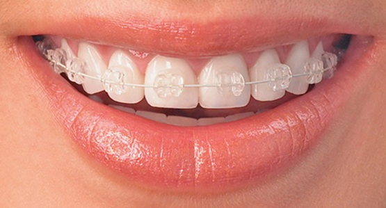 Brackets de porcelana