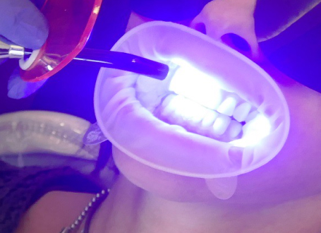 Blanqueamientos dentales