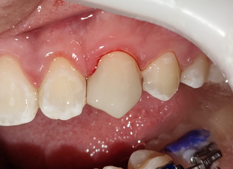 Restauraciones estéticas